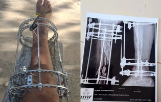 Jovem aguarda cirurgia há quase dois anos após acidente e família denuncia demora em Guanambi