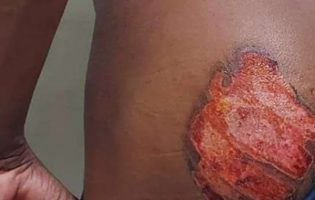 Livramento de Nossa Senhora: Acusados de marcar jovem negro e surdo-mudo com ferro quente nas nádegas são presos